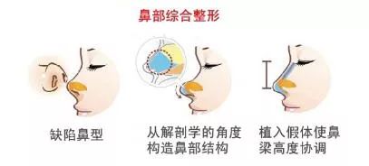 【口碑解读】淄博整形医生于洪光的鼻部综合整形