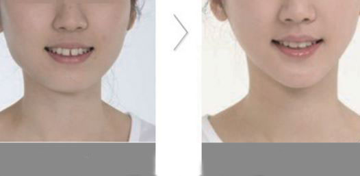 咬肌切除手術(shù)方法如何