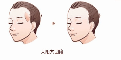 北京注射豐太陽穴取出價格是多少