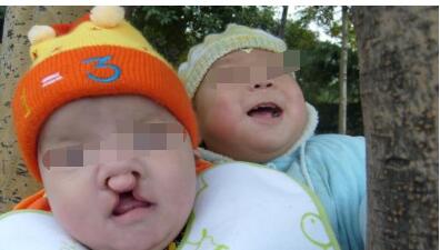 唇腭裂治療常用的四種方法