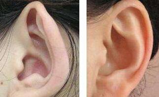 是不是所有招風(fēng)耳都要通過手術(shù)矯正?