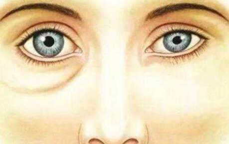 眼袋的形成會(huì)讓面部出現(xiàn)影響