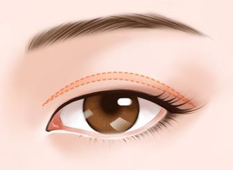 ��h�p��Ƥʧ���ޏ�(f��)���g(sh��)�ăr���Ƕ���