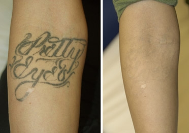 激光去川字纹激光去除川字线需要多少钱