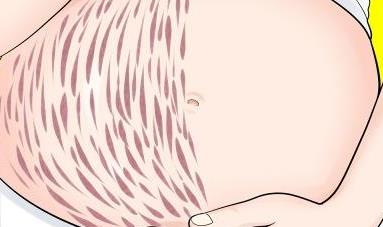 產(chǎn)后肚臍下難看又丑的妊娠紋該怎么消除?