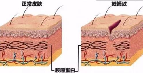 產(chǎn)后肚臍下難看又丑的妊娠紋該怎么消除?