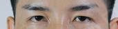 眼瞼下垂矯正手術(shù),從無神到有神還變得帥氣很多