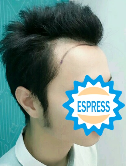 發(fā)際線種植手術(shù)解決了我的困擾