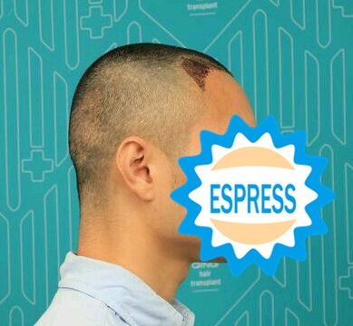 發(fā)際線種植手術(shù)解決了我的困擾