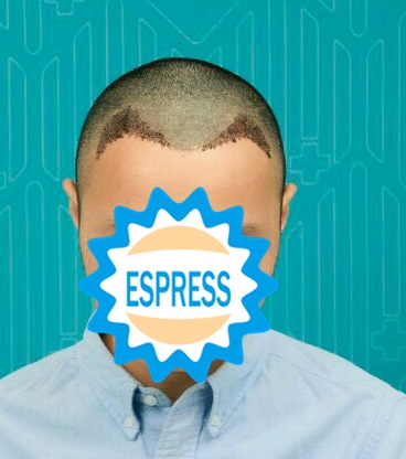 發(fā)際線種植手術(shù)解決了我的困擾