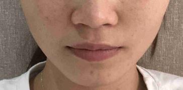 臉上的脂肪存活的很好