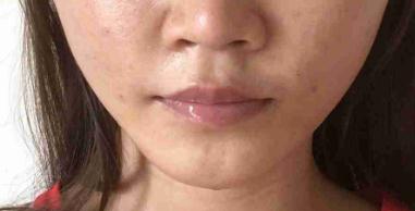 臉上的脂肪存活的很好