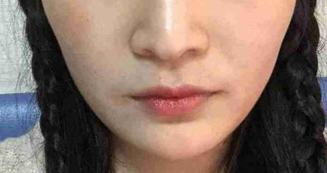 做了下颌角整形后脸型越来自然了