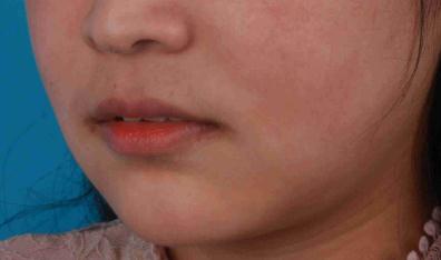 做了下颌角整形后脸型越来自然了