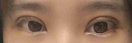 双眼皮特别自然有神,朋友都说我双眼皮做的很好