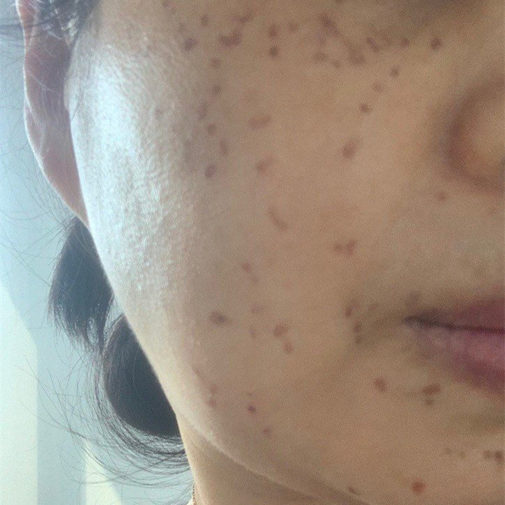 祛斑效果令人驚艷,臉上干凈美麗