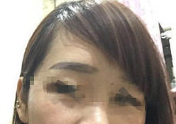 激光去痘印改善了我的面部肌膚,人也變得自信了