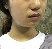 皮膚松弛選擇熱瑪吉準(zhǔn)沒錯