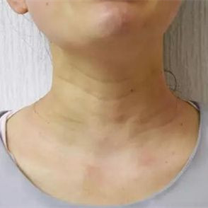 做了除皱手术,让我皮肤不老化,彰显年轻气息