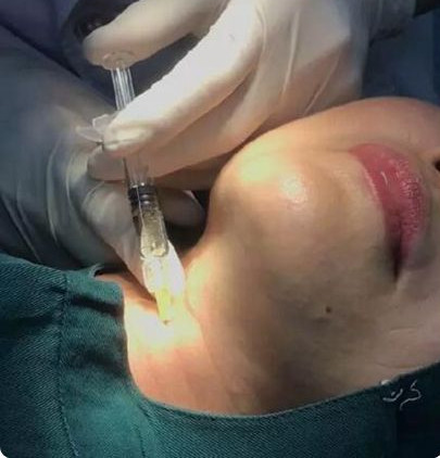 做了除皱手术,让我皮肤不老化,彰显年轻气息