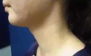 做了除皱手术,让我皮肤不老化,彰显年轻气息