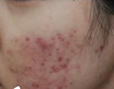 激光祛除痘印讓我又恢復(fù)了自信生活