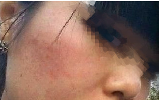 激光祛除痘印讓我又恢復(fù)了自信生活