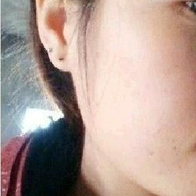 激光祛除痘印讓我又恢復(fù)了自信生活