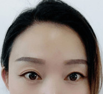 雙眼皮手術(shù)的讓我變得更加自信了