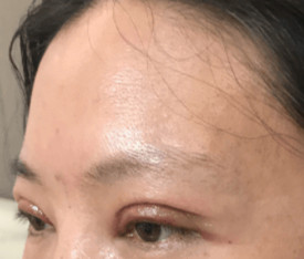 雙眼皮手術(shù)的讓我變得更加自信了