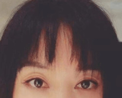 雙眼皮手術(shù)的讓我變得更加自信了