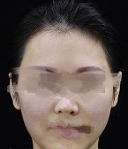 面部輪廓改善后人都變得自信了起來(lái)