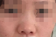鼻部综合手术让我有一个精致鼻子，魅力更上一层楼