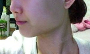 下頜角整形讓自己變漂亮了很多,人都變年輕了