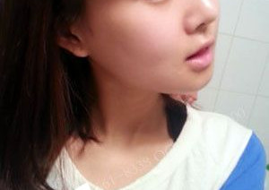 下頜角整形讓自己變漂亮了很多,人都變年輕了