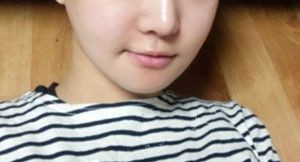 下頜角整形讓自己變漂亮了很多,人都變年輕了