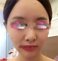 做了面部除皺后我的臉都小了一圈呢