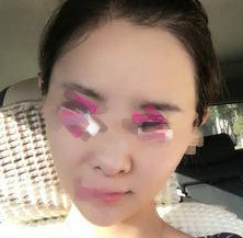 做了面部除皺后我的臉都小了一圈呢