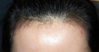要秃顶了不要慌，毛发种植术有效改善秃顶尴尬