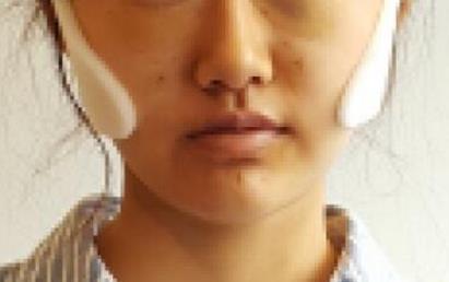 ���w֬���沿������g(sh��):Ę���Ĵ�׃��M����