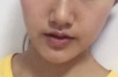 ���w֬���沿������g(sh��):Ę���Ĵ�׃��M����