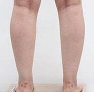 小腿吸脂减肥会影响走路吗