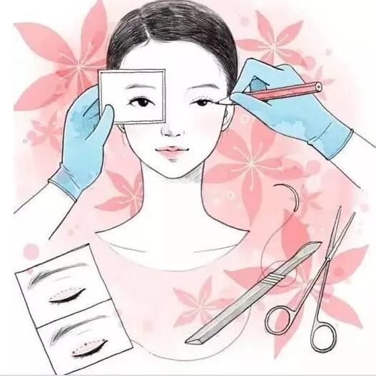 双眼皮术后恢复你了解多少?